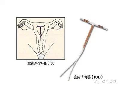 元宫型CU365节育环安装过程视频，一个普通女性的真实记录与科普