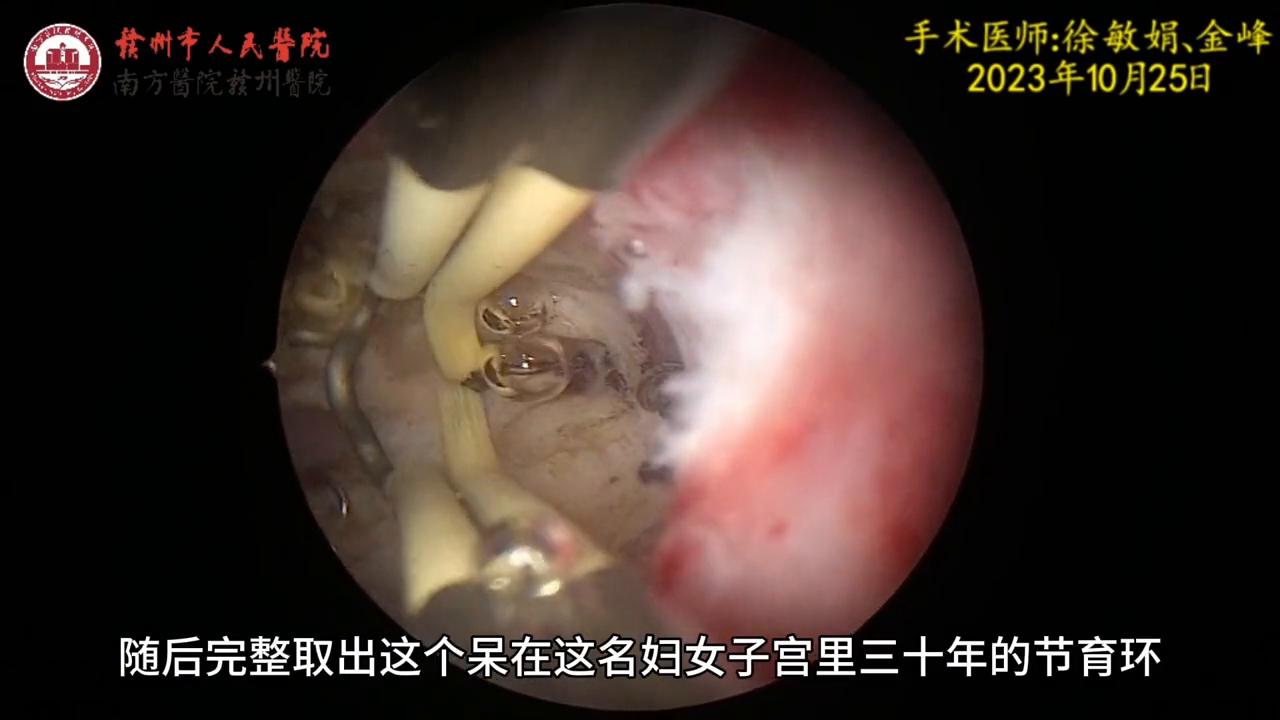 元宫型CU365节育环放取视频，一次说清楚，让你心里有底