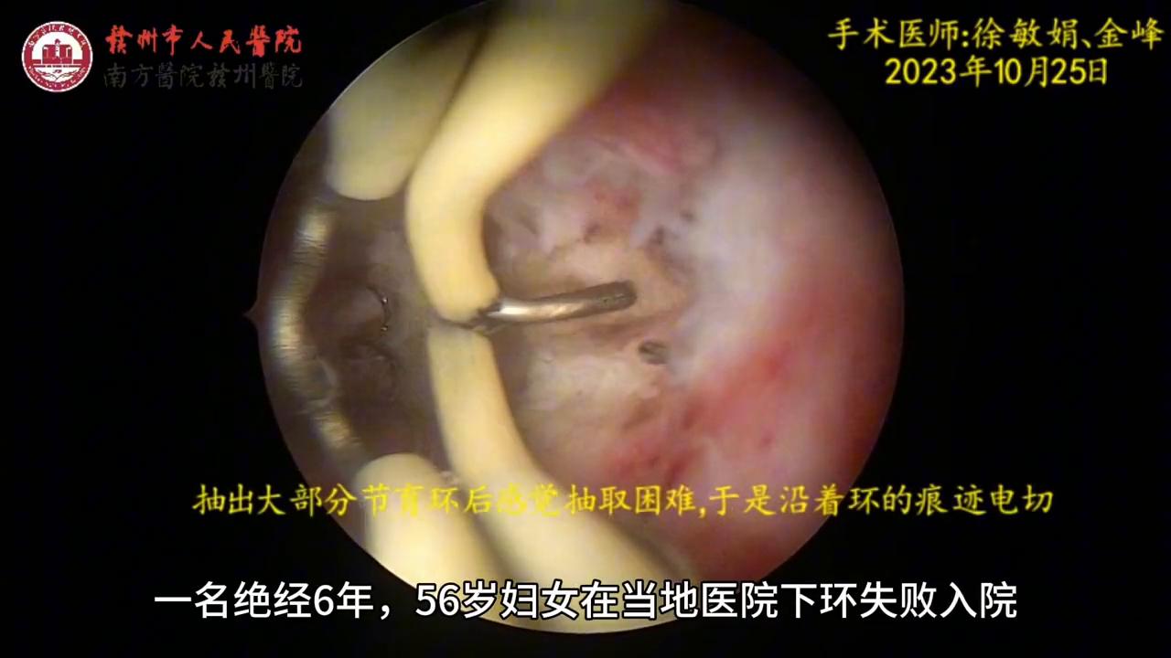 元宫型CU365节育环放取视频，一个妇产科医生的手记